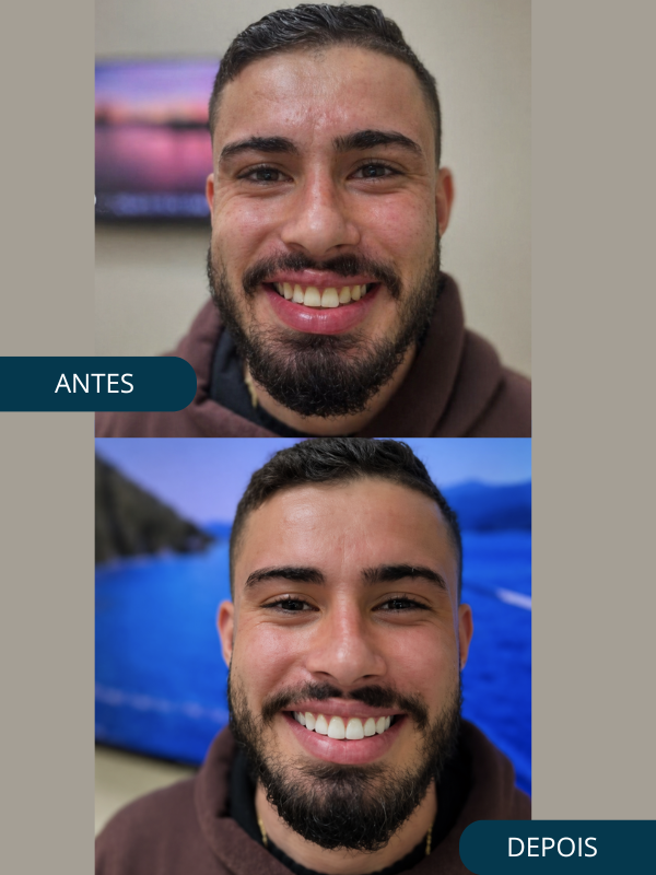 Antes e Depois - Odonto Help